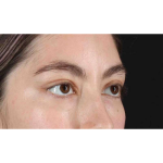 Eyelid Surgery Before & After Patient #1836