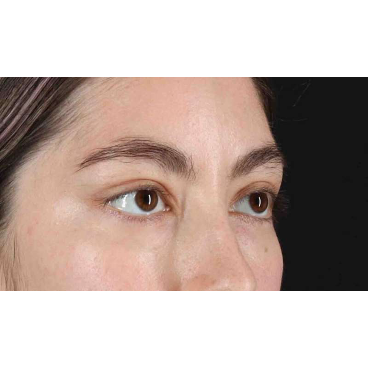 Eyelid Surgery Before & After Patient #1836