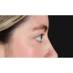 Eyelid Surgery Before & After Patient #1836