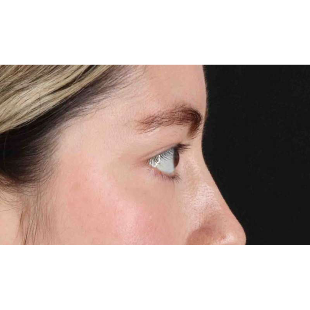 Eyelid Surgery Before & After Patient #1836