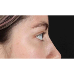 Eyelid Surgery Before & After Patient #1836