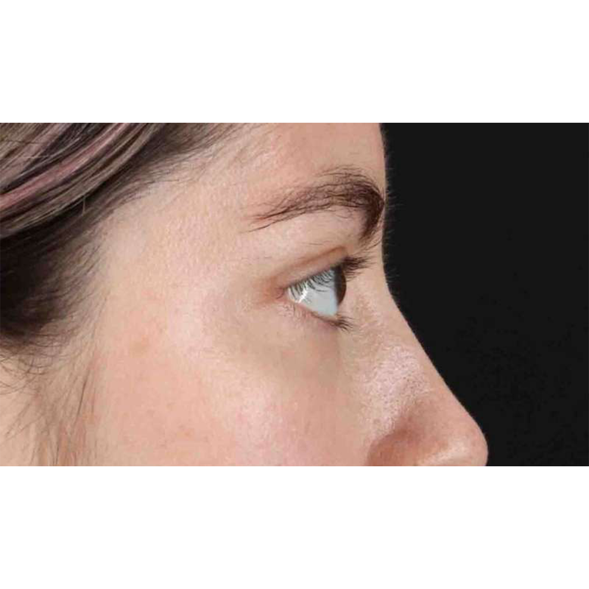 Eyelid Surgery Before & After Patient #1836