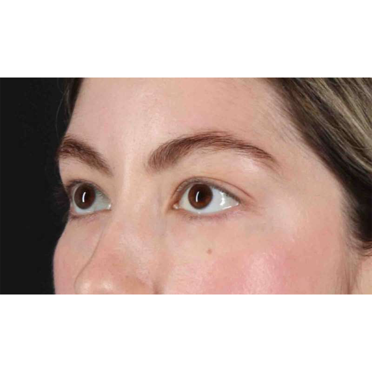 Eyelid Surgery Before & After Patient #1836