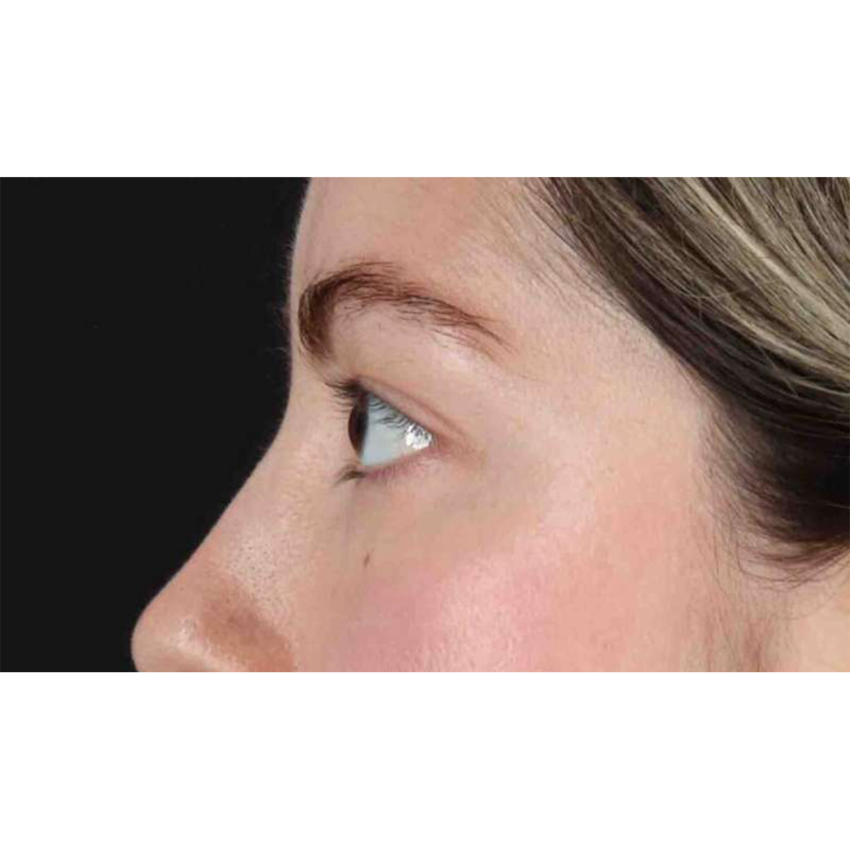 Eyelid Surgery Before & After Patient #1836