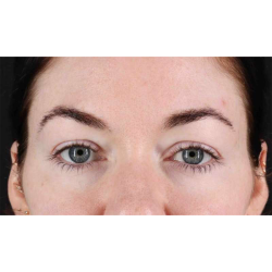 Eyelid Surgery Before & After Patient #1847