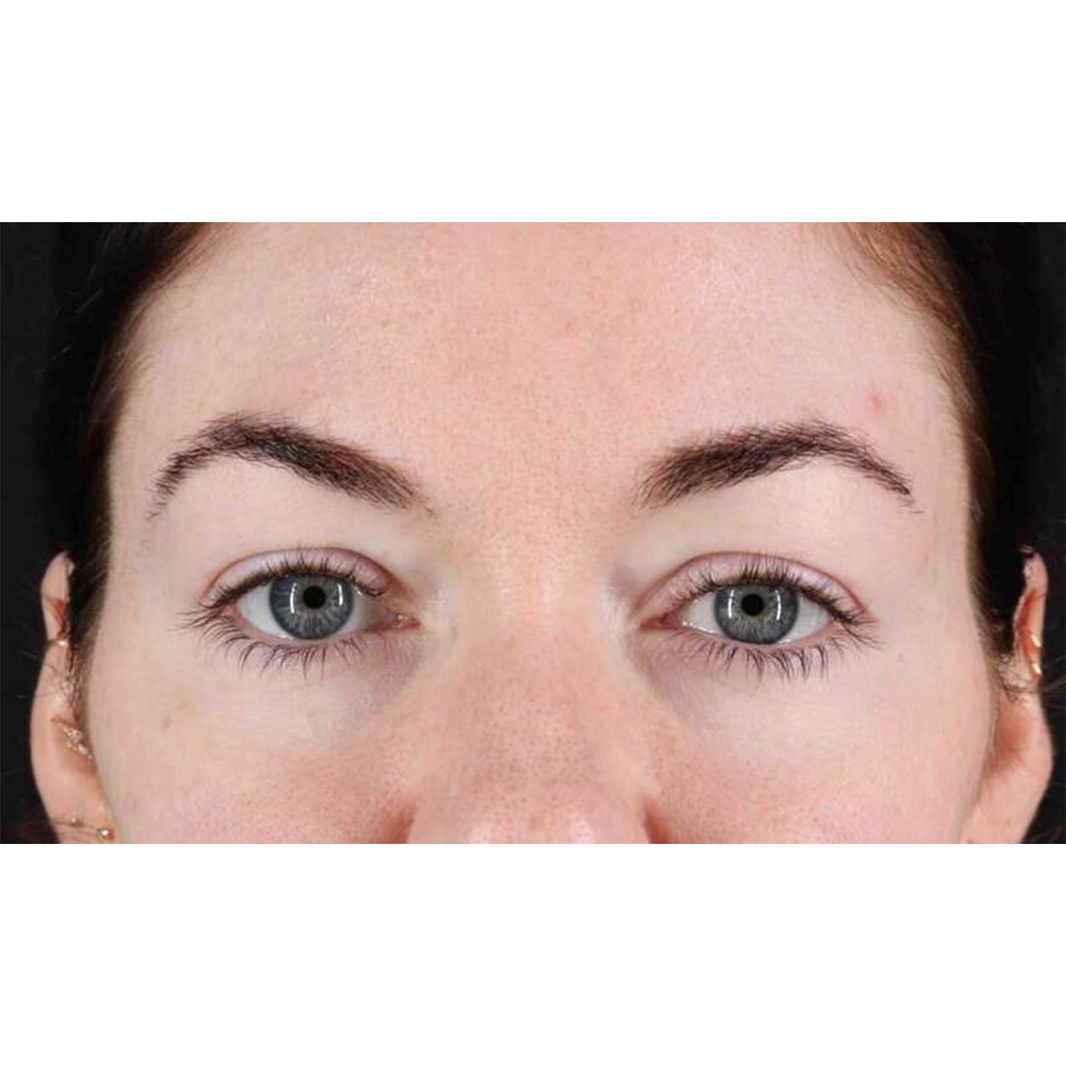 Eyelid Surgery Before & After Patient #1847