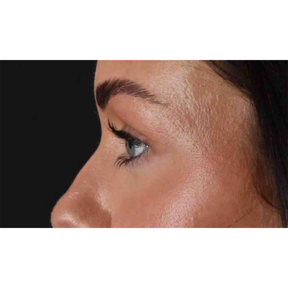 Eyelid Surgery Before & After Patient #1847