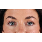 Eyelid Surgery Before & After Patient #1847