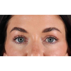 Eyelid Surgery Before & After Patient #1847