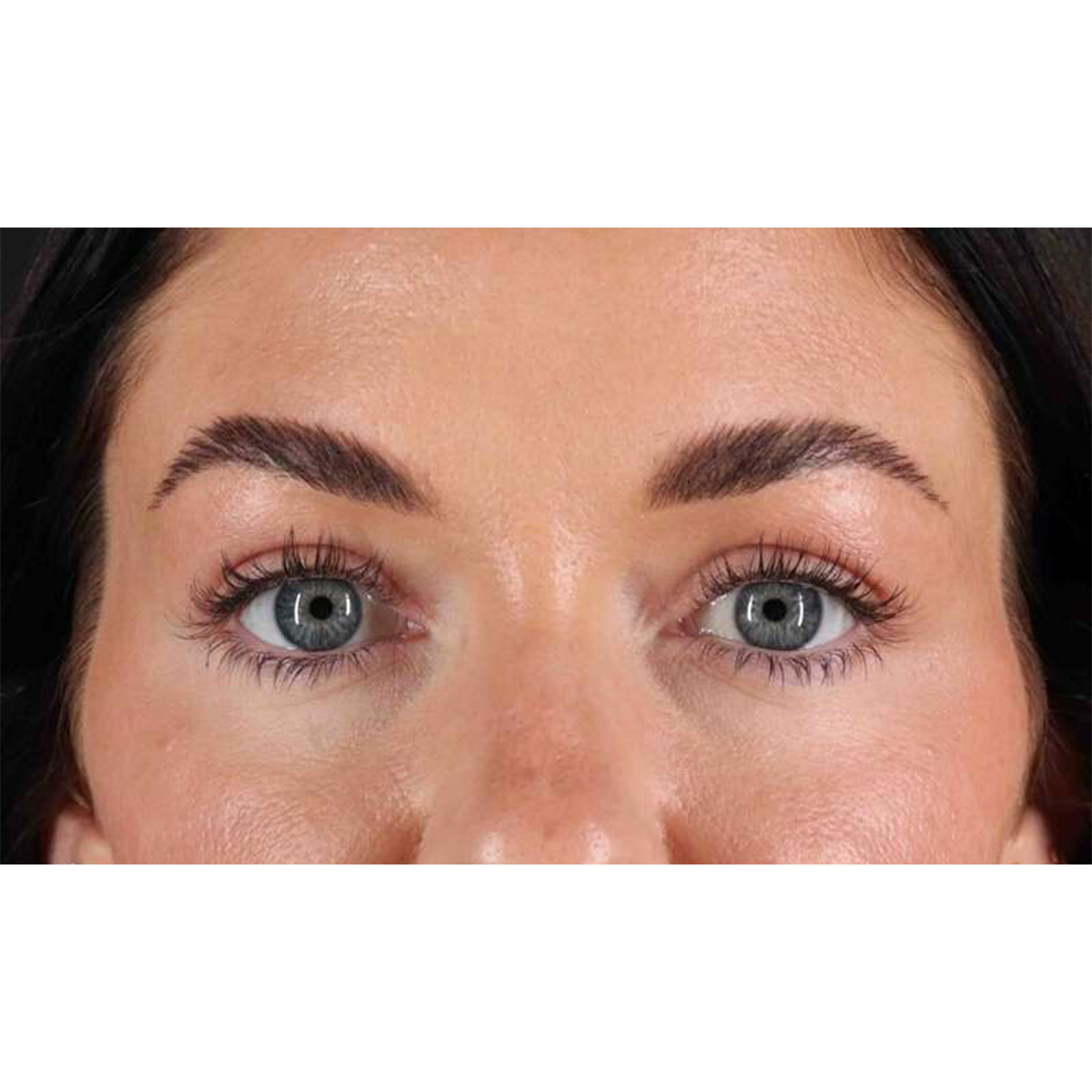 Eyelid Surgery Before & After Patient #1847