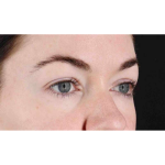 Eyelid Surgery Before & After Patient #1847