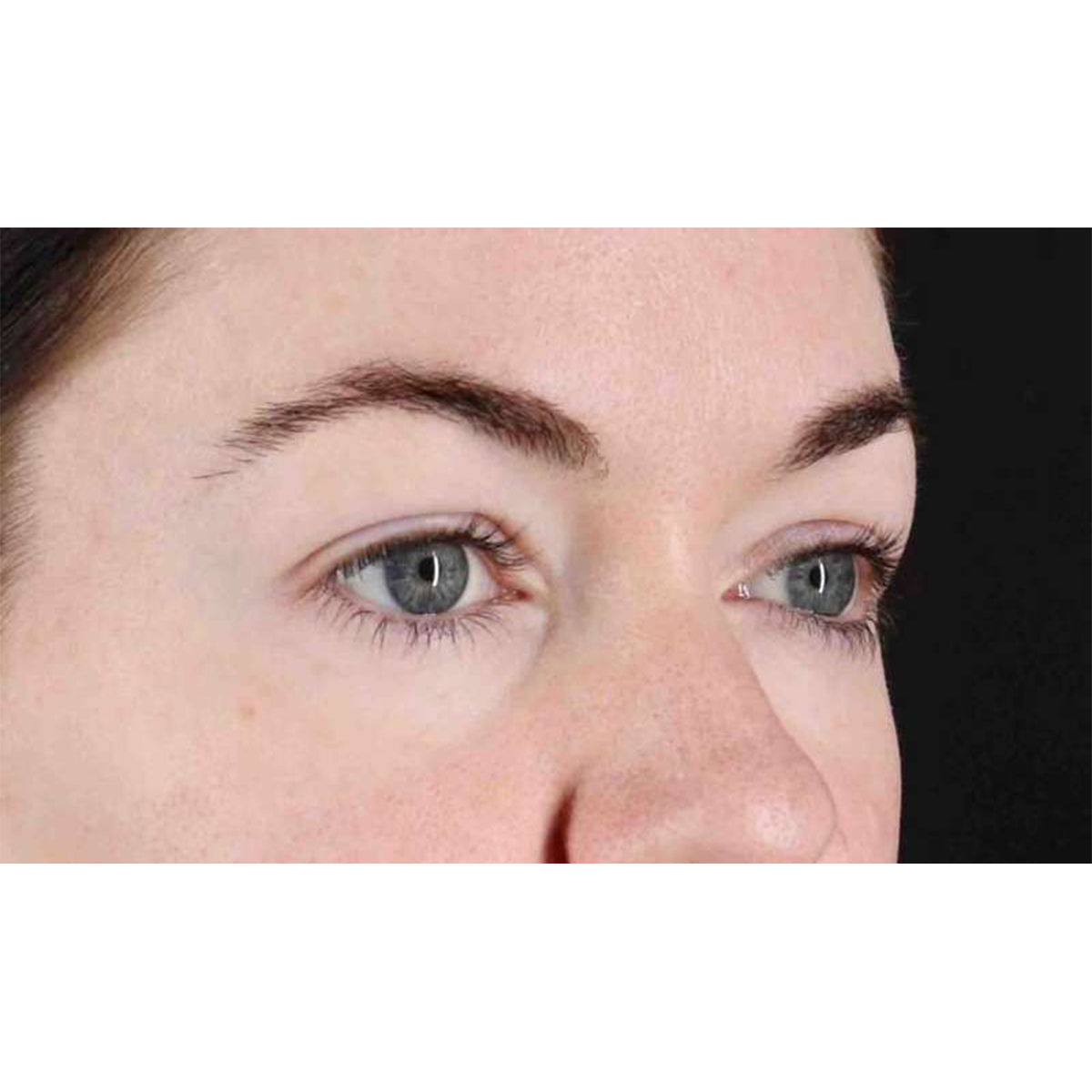 Eyelid Surgery Before & After Patient #1847