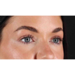 Eyelid Surgery Before & After Patient #1847