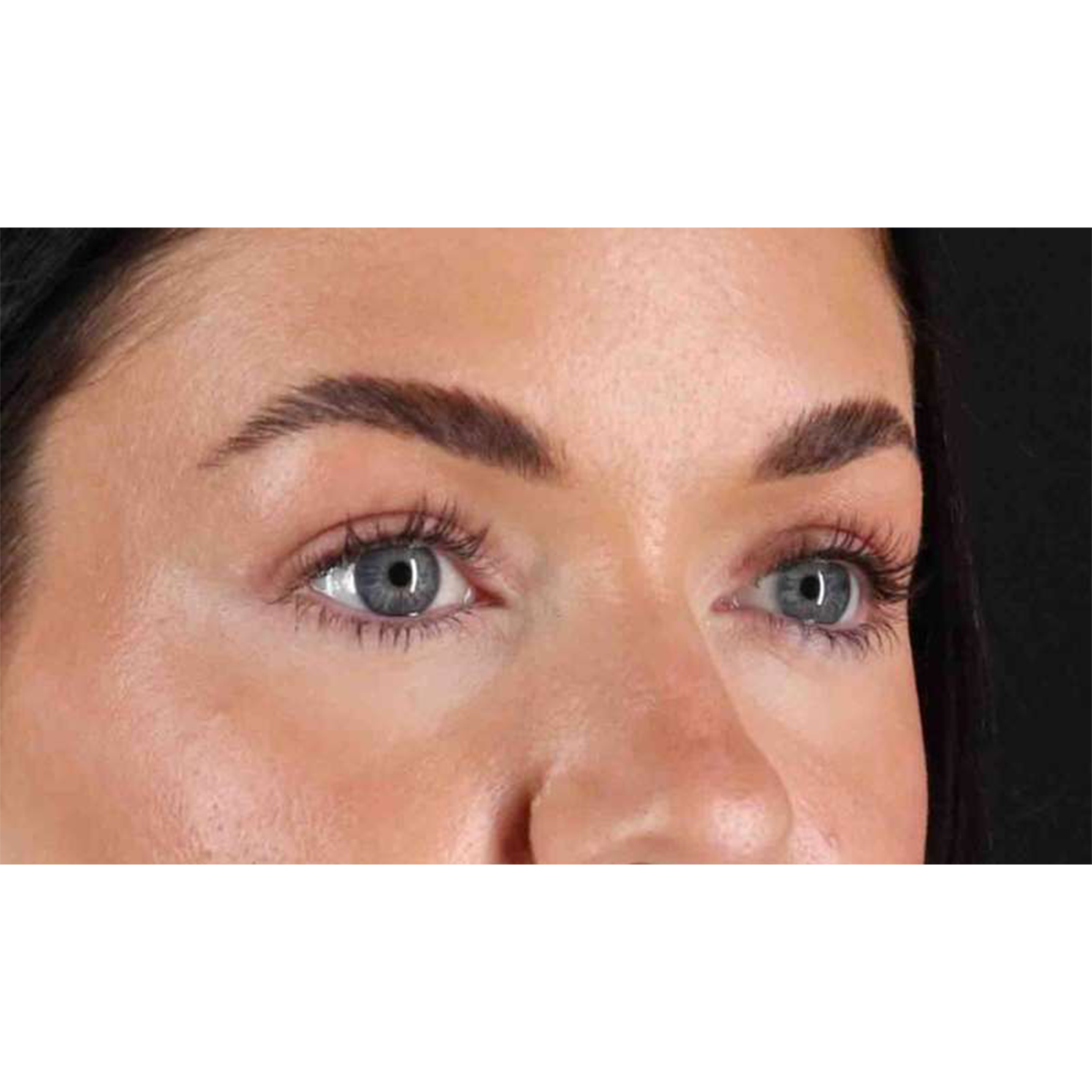 Eyelid Surgery Before & After Patient #1847