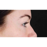 Eyelid Surgery Before & After Patient #1847