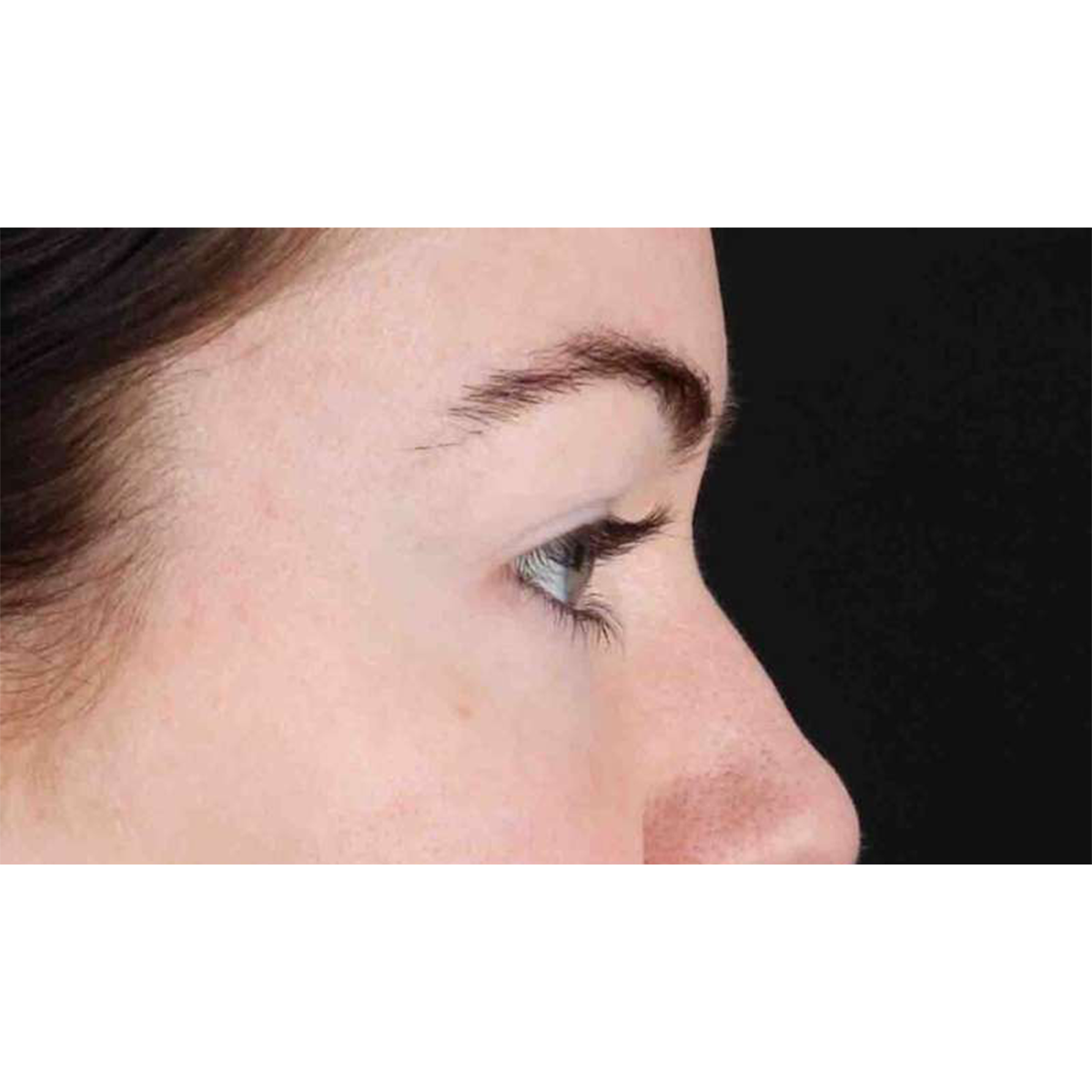 Eyelid Surgery Before & After Patient #1847