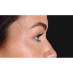Eyelid Surgery Before & After Patient #1847
