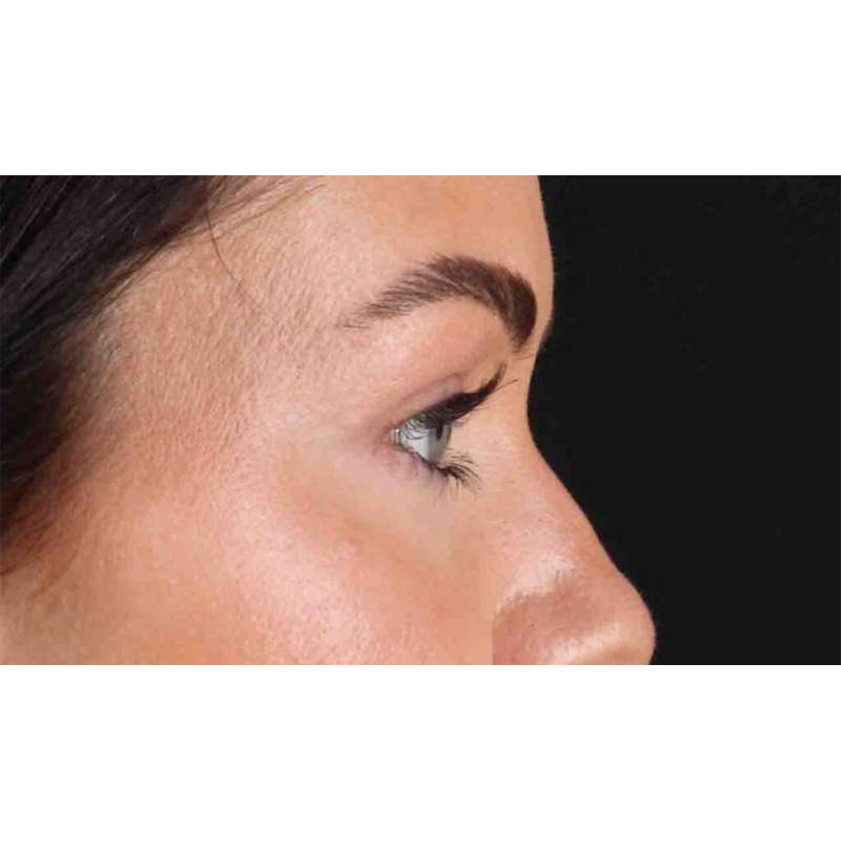 Eyelid Surgery Before & After Patient #1847