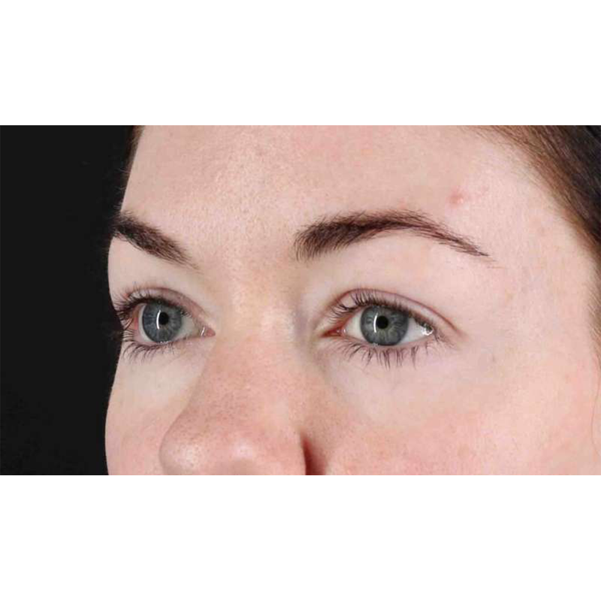 Eyelid Surgery Before & After Patient #1847