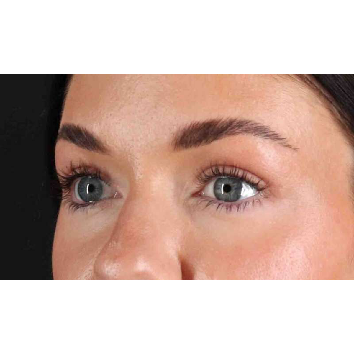 Eyelid Surgery Before & After Patient #1847