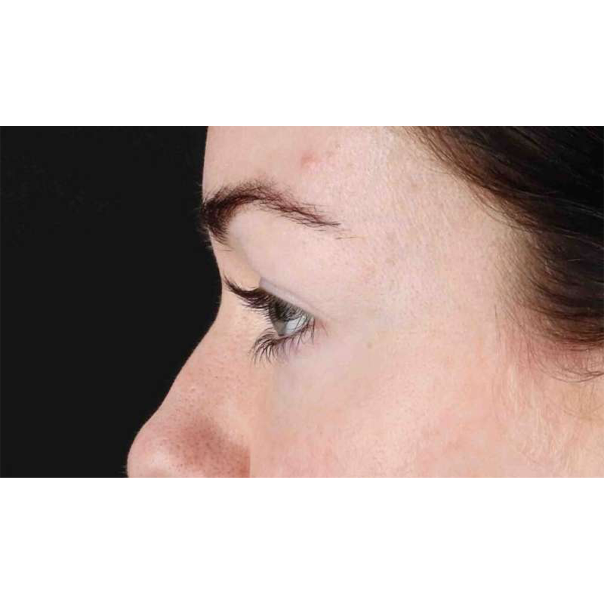 Eyelid Surgery Before & After Patient #1847
