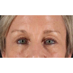 Eyelid Surgery Before & After Patient #1858