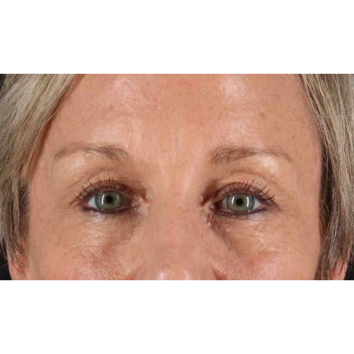 Eyelid Surgery Before & After Patient #1858