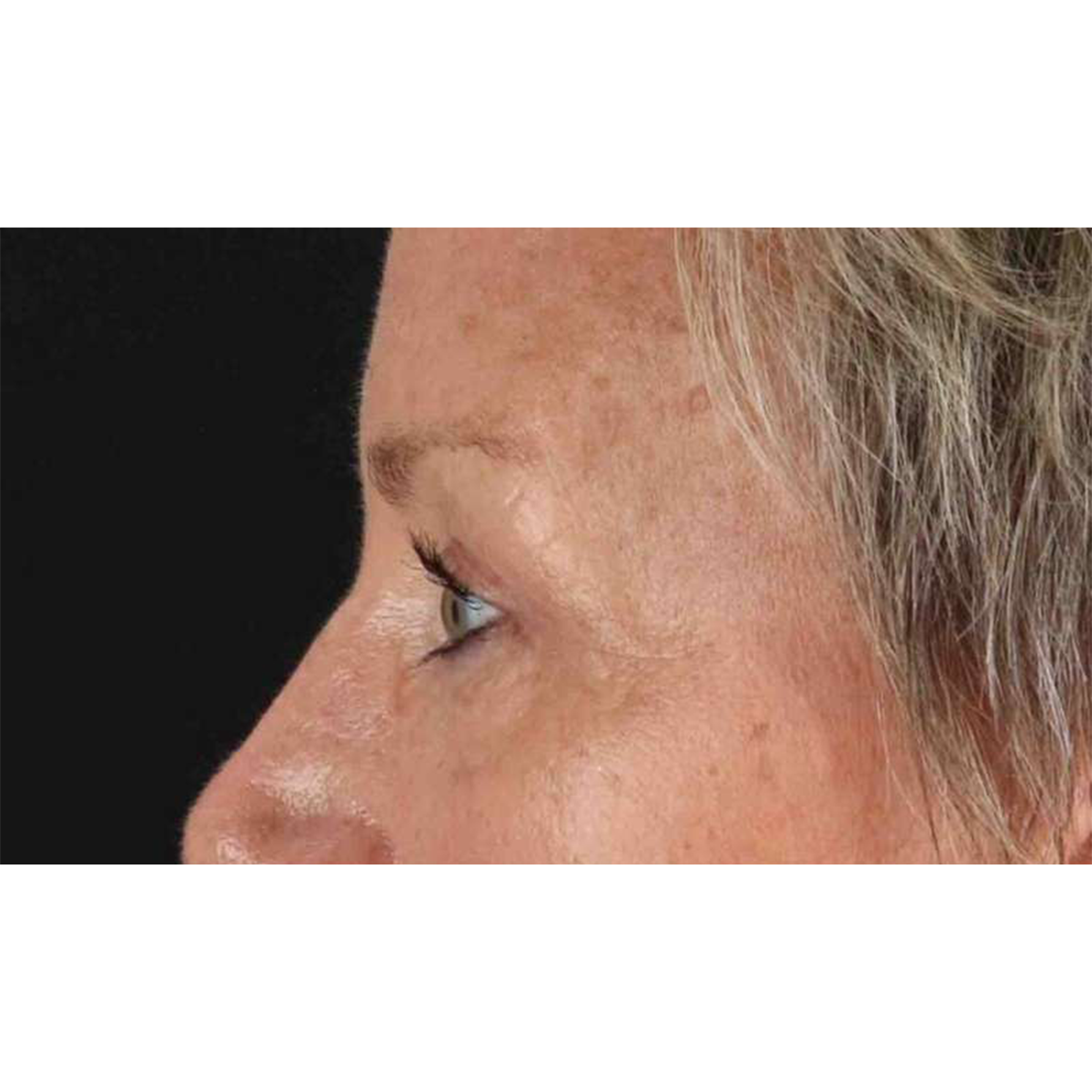 Eyelid Surgery Before & After Patient #1858
