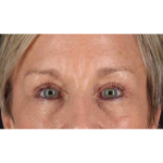 Eyelid Surgery Before & After Patient #1858