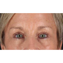 Eyelid Surgery Before & After Patient #1858
