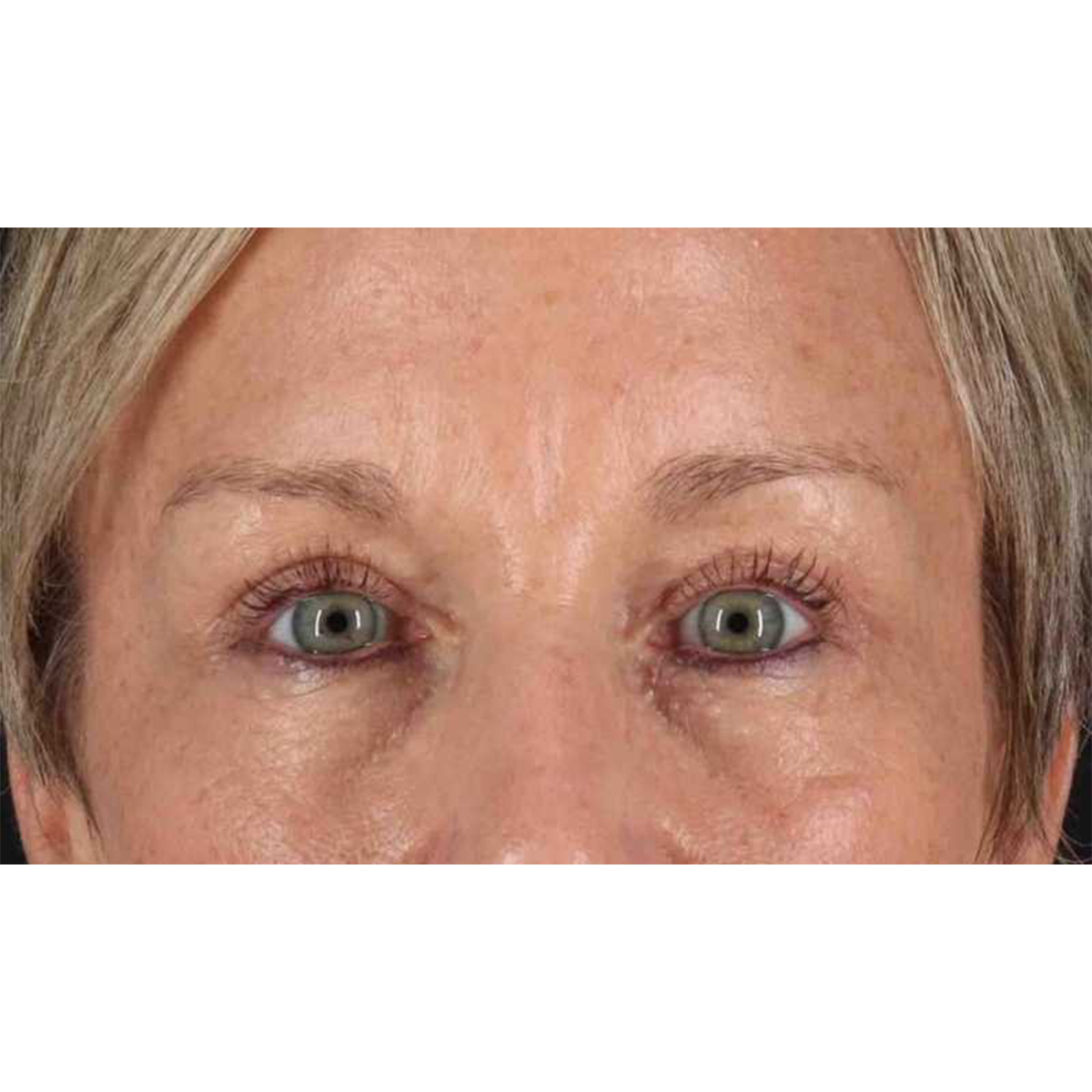 Eyelid Surgery Before & After Patient #1858