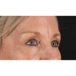 Eyelid Surgery Before & After Patient #1858