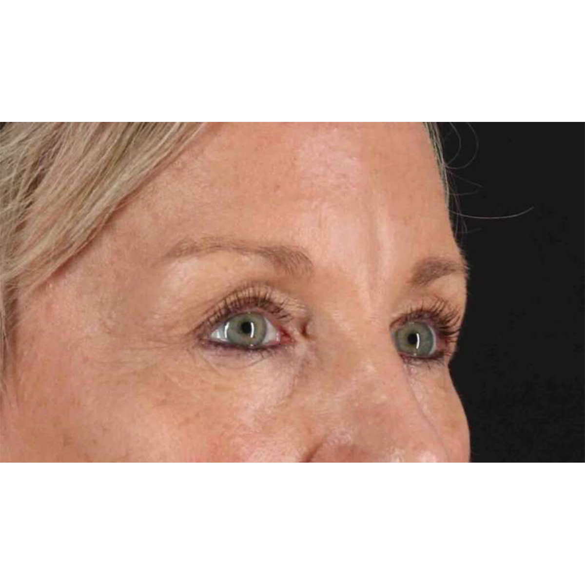 Eyelid Surgery Before & After Patient #1858