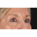 Eyelid Surgery Before & After Patient #1858