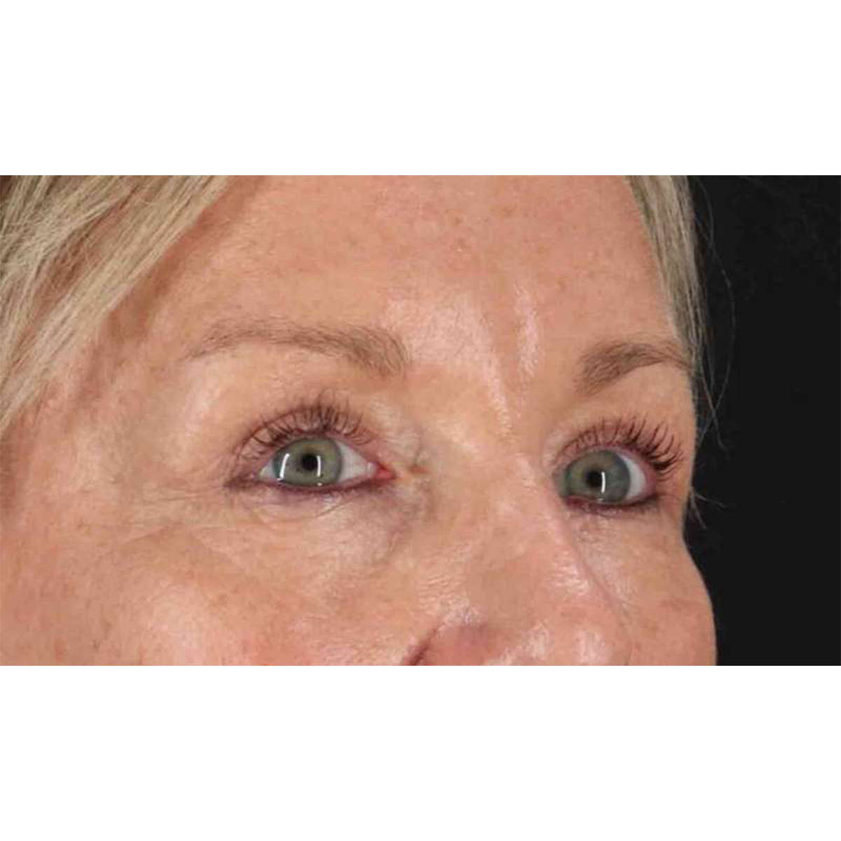 Eyelid Surgery Before & After Patient #1858