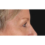 Eyelid Surgery Before & After Patient #1858