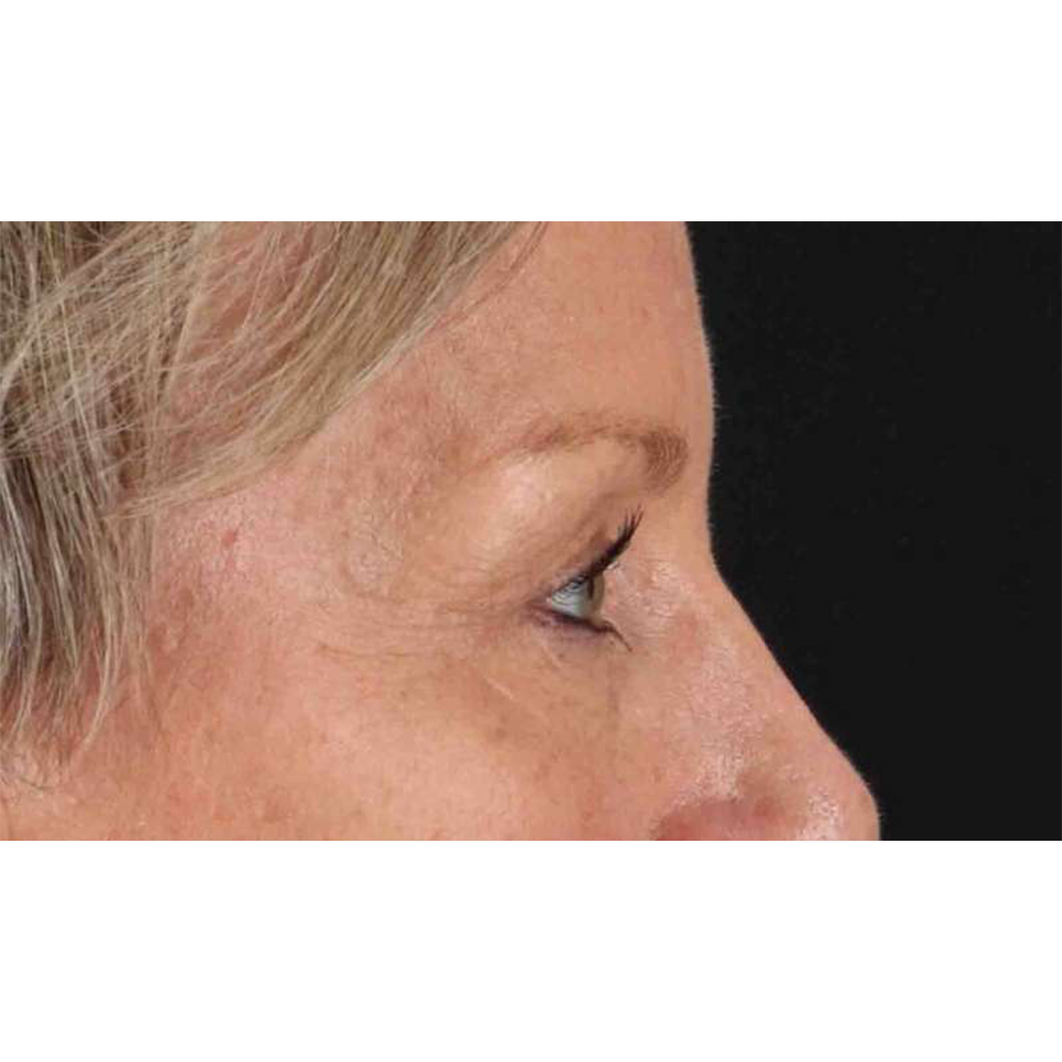 Eyelid Surgery Before & After Patient #1858