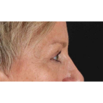 Eyelid Surgery Before & After Patient #1858
