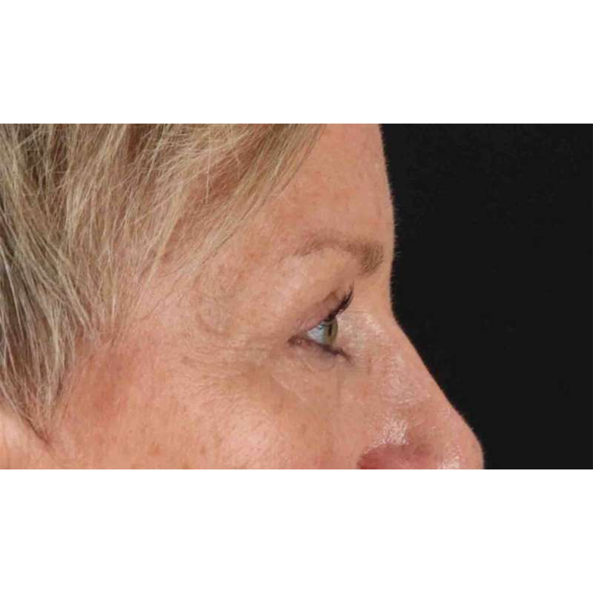 Eyelid Surgery Before & After Patient #1858