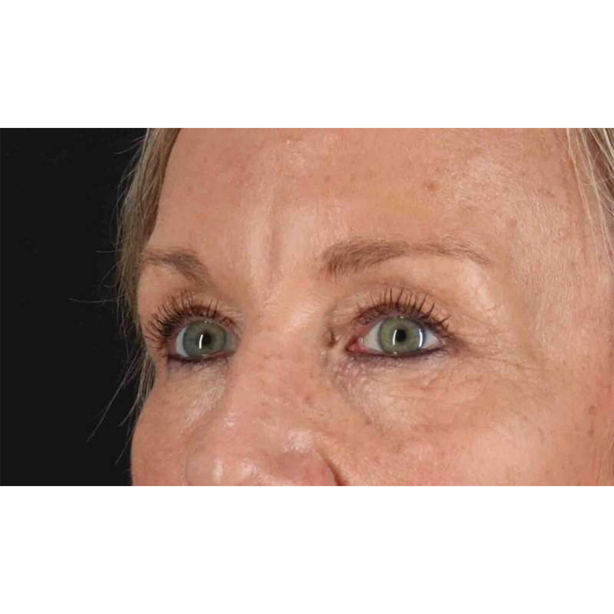 Eyelid Surgery Before & After Patient #1858