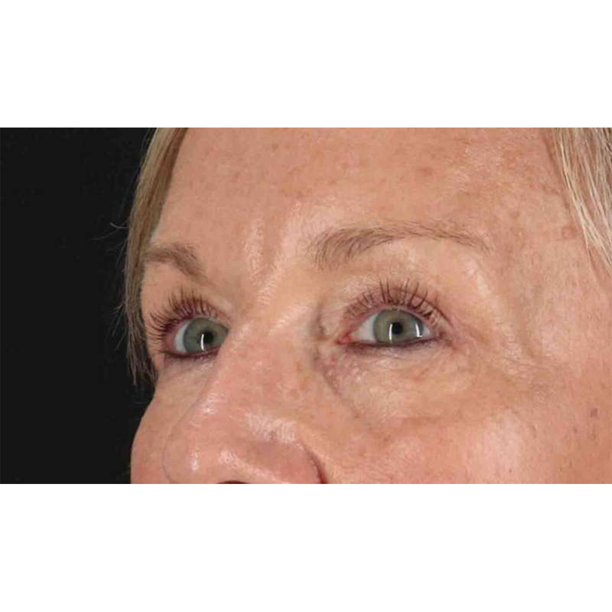 Eyelid Surgery Before & After Patient #1858