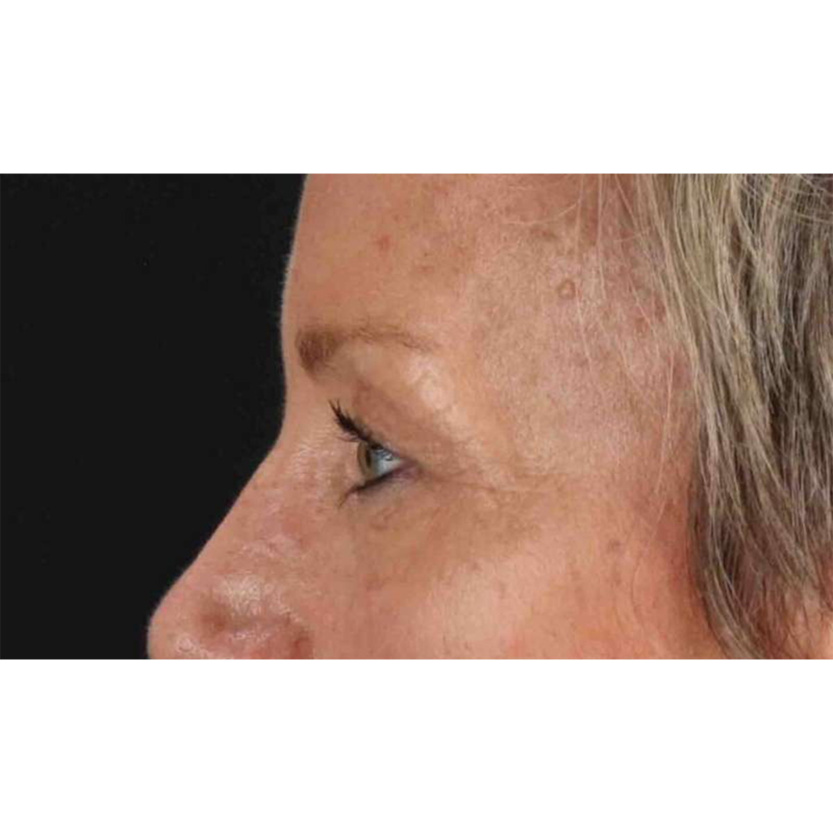 Eyelid Surgery Before & After Patient #1858