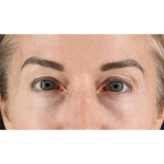 Eyelid Surgery Before & After Patient #1869