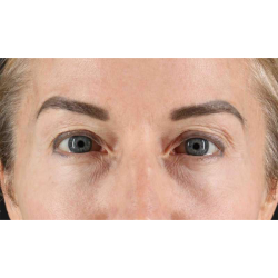 Eyelid Surgery Before & After Patient #1869