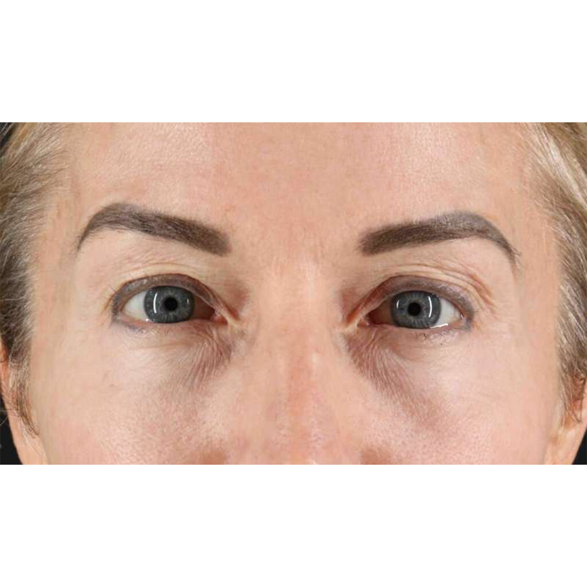 Eyelid Surgery Before & After Patient #1869