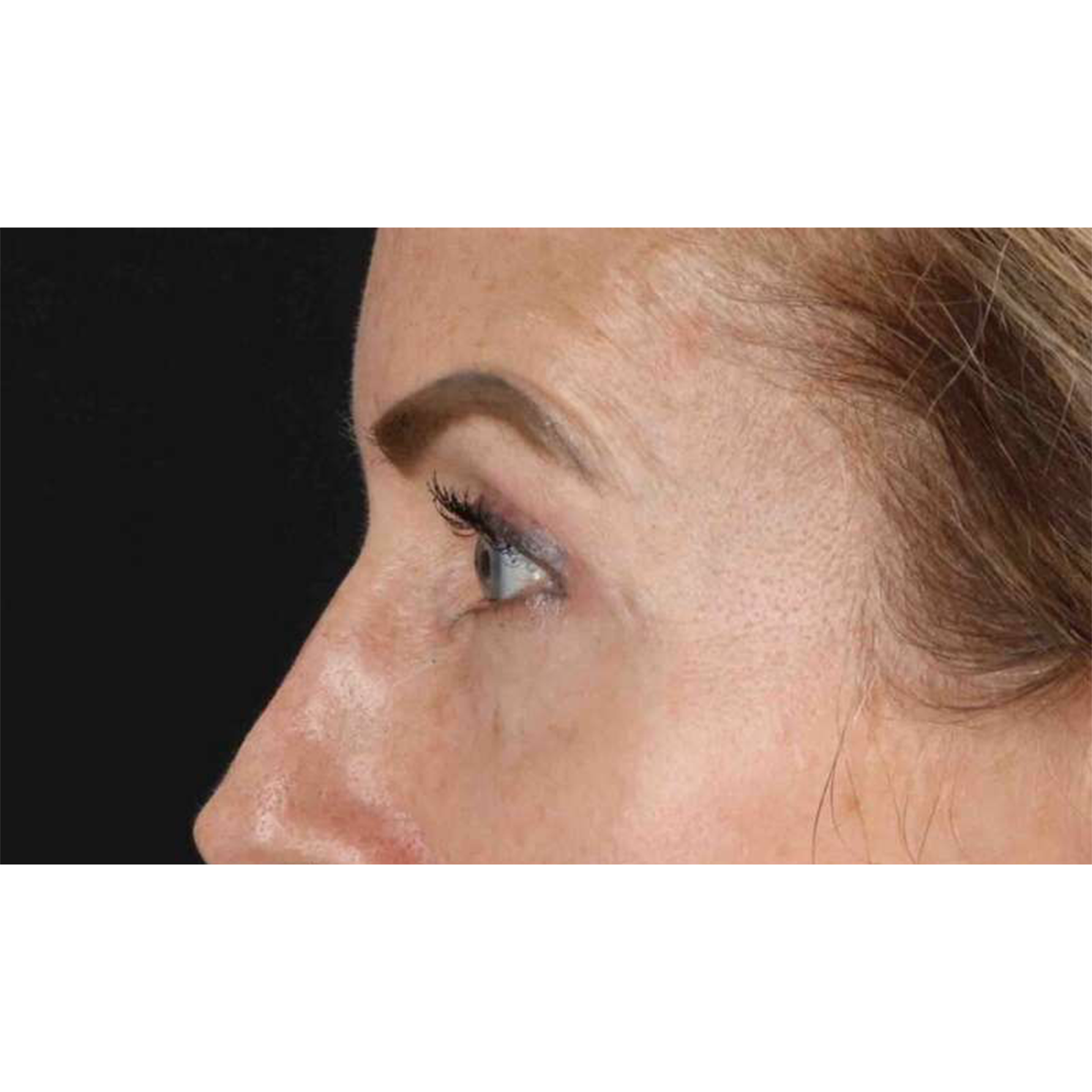 Eyelid Surgery Before & After Patient #1869