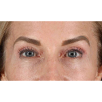 Eyelid Surgery Before & After Patient #1869