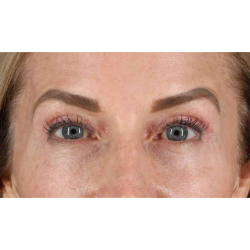 Eyelid Surgery Before & After Patient #1869