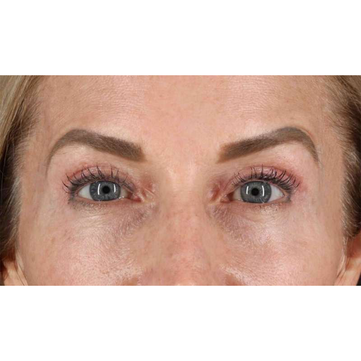 Eyelid Surgery Before & After Patient #1869