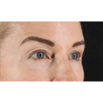 Eyelid Surgery Before & After Patient #1869